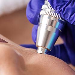 Microneedling